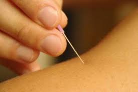 Dry Needling2